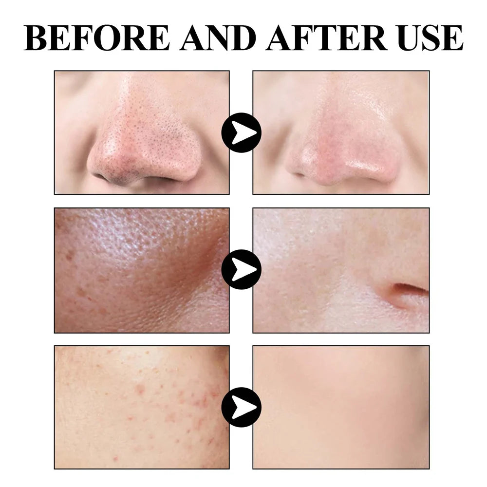 West Month Blackhead Removal Mud Mask for Oil Control and Pores